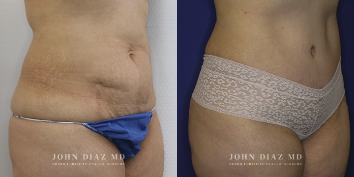 Dr John Diaz Before and After | Tummy Tuck