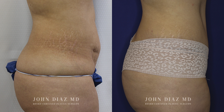 Dr John Diaz Before and After | Tummy Tuck