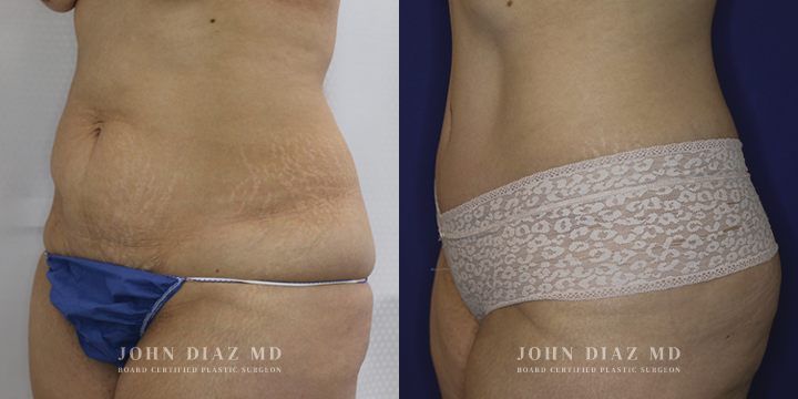 Dr John Diaz Before and After | Tummy Tuck