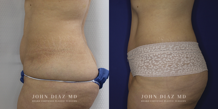 Dr John Diaz Before and After | Tummy Tuck