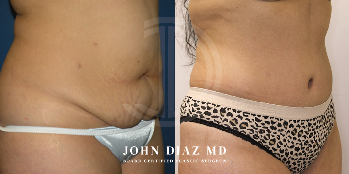 Dr John Diaz Before and After | Tummy Tuck