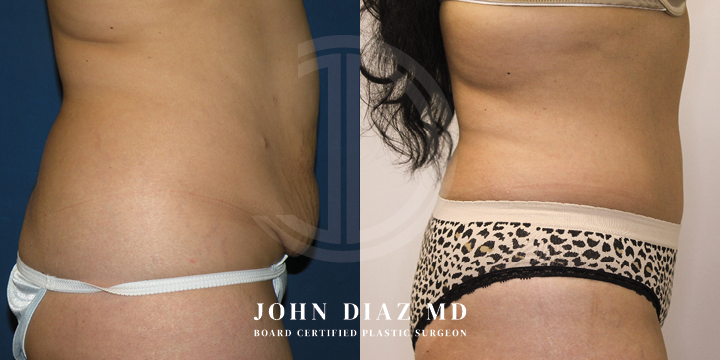 Dr John Diaz Before and After | Tummy Tuck