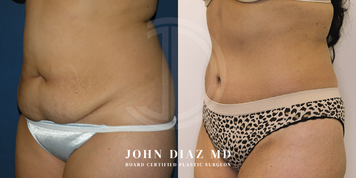 Dr John Diaz Before and After | Tummy Tuck