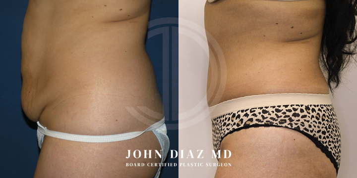 Dr John Diaz Before and After | Tummy Tuck