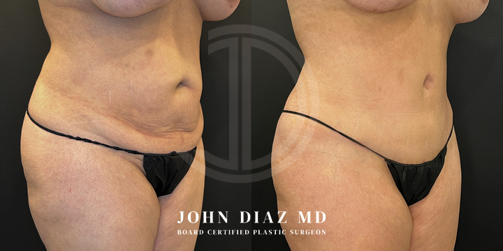 Dr John Diaz Before and After | Tummy Tuck