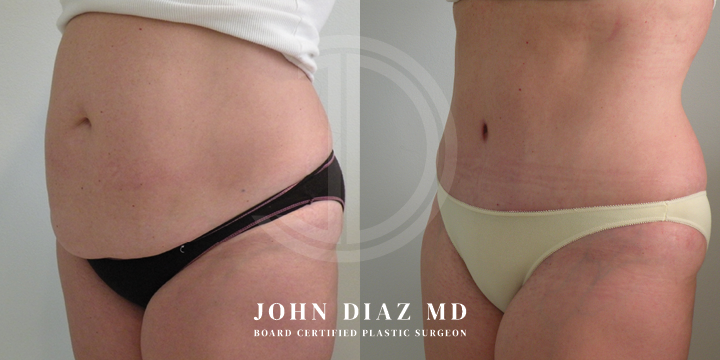 Dr John Diaz Before and After | Tummy Tuck