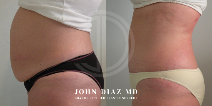 Dr John Diaz Before and After | Tummy Tuck