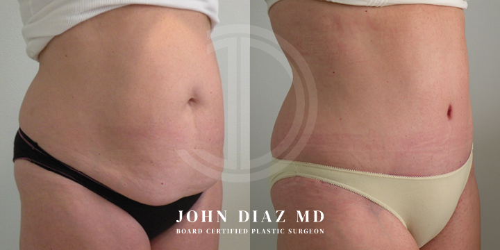 Dr John Diaz Before and After | Tummy Tuck