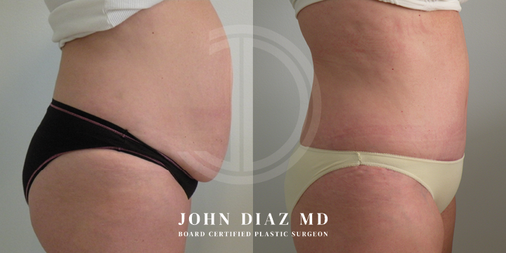 Dr John Diaz Before and After | Tummy Tuck