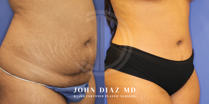 Dr John Diaz Before and After | Tummy Tuck