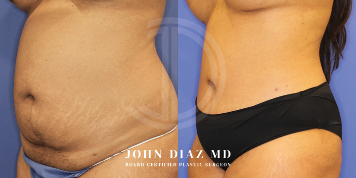 Dr John Diaz Before and After | Tummy Tuck