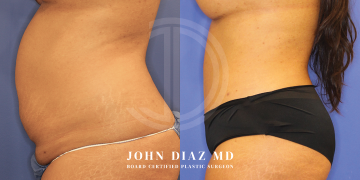 Dr John Diaz Before and After | Tummy Tuck