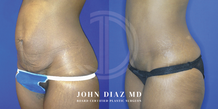 Dr John Diaz Before and After | Tummy Tuck