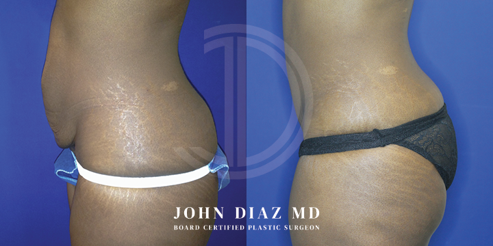 Dr John Diaz Before and After | Tummy Tuck