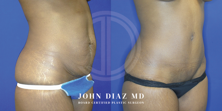 Dr John Diaz Before and After | Tummy Tuck