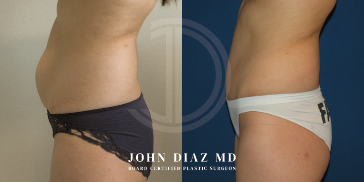 Dr John Diaz Before and After | Tummy Tuck