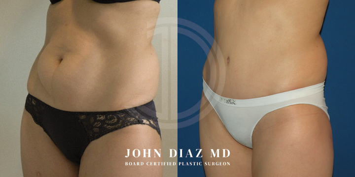 Dr John Diaz Before and After | Tummy Tuck
