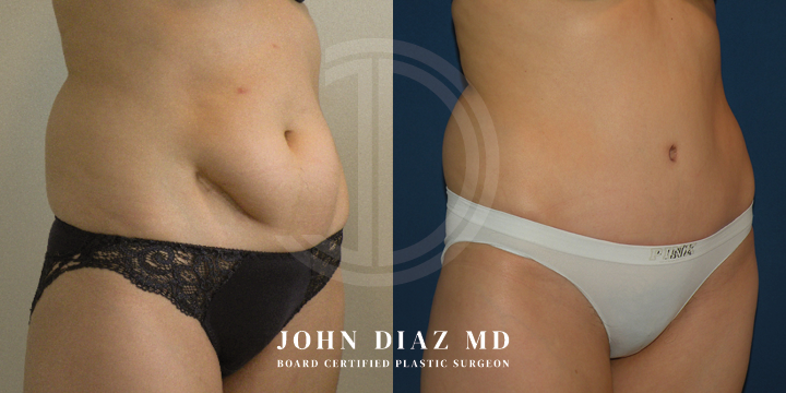 Dr John Diaz Before and After | Tummy Tuck