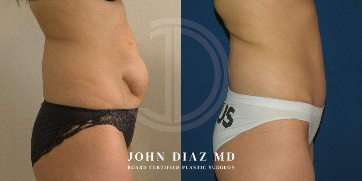 Dr John Diaz Before and After | Tummy Tuck