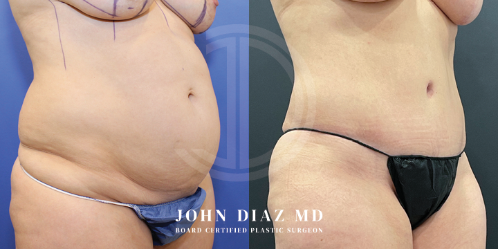 Dr John Diaz Before and After | Tummy Tuck