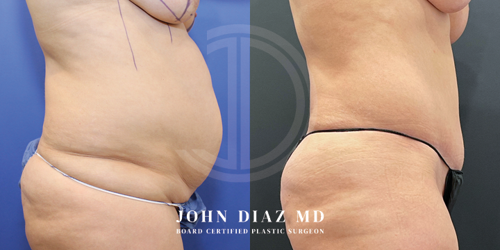 Dr John Diaz Before and After | Tummy Tuck