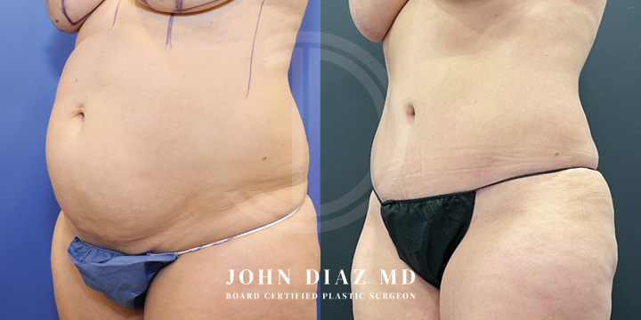 Dr John Diaz Before and After | Tummy Tuck
