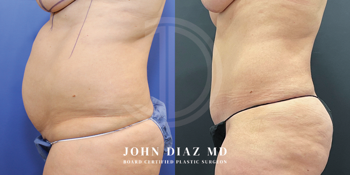Dr John Diaz Before and After | Tummy Tuck