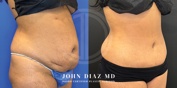 Dr John Diaz Before and After | Tummy Tuck