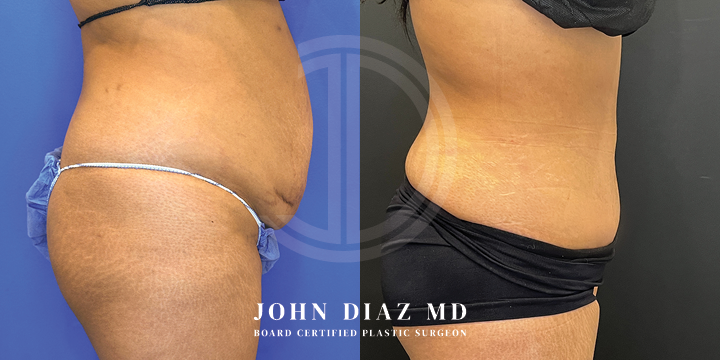 Dr John Diaz Before and After | Tummy Tuck