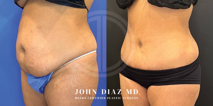 Dr John Diaz Before and After | Tummy Tuck