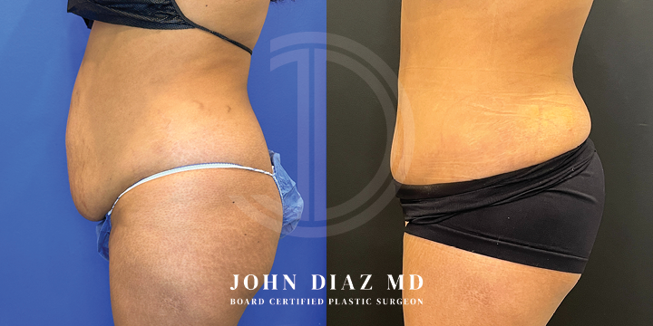 Dr John Diaz Before and After | Tummy Tuck