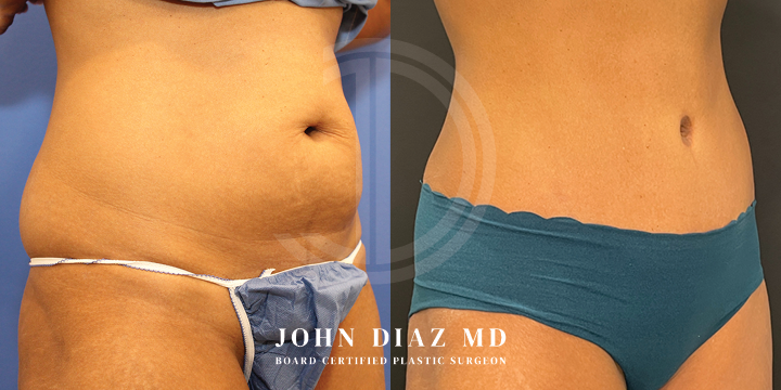 Dr John Diaz Before and After | Tummy Tuck