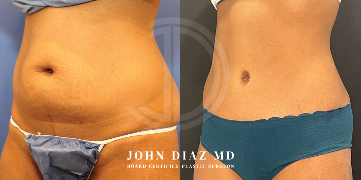 Dr John Diaz Before and After | Tummy Tuck