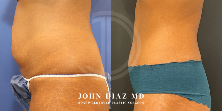Dr John Diaz Before and After | Tummy Tuck
