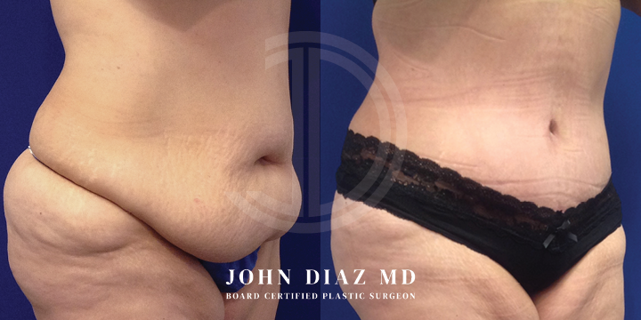 Dr John Diaz Before and After | Tummy Tuck