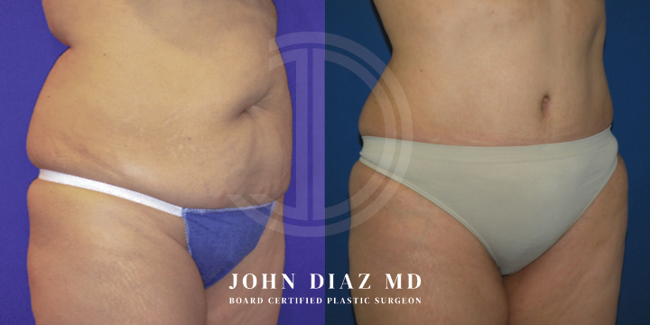 Dr John Diaz Before and After | Tummy Tuck