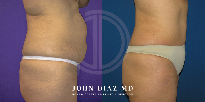Dr John Diaz Before and After | Tummy Tuck