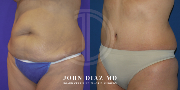Dr John Diaz Before and After | Tummy Tuck