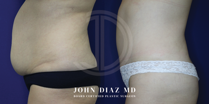 Dr John Diaz Before and After | Tummy Tuck