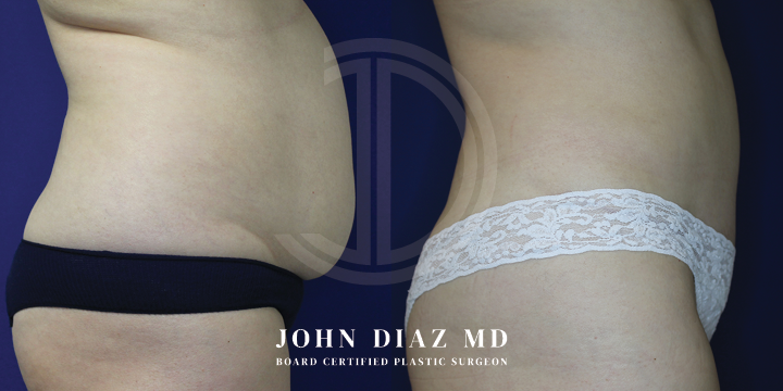 Dr John Diaz Before and After | Tummy Tuck