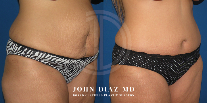 Dr John Diaz Before and After | Tummy Tuck