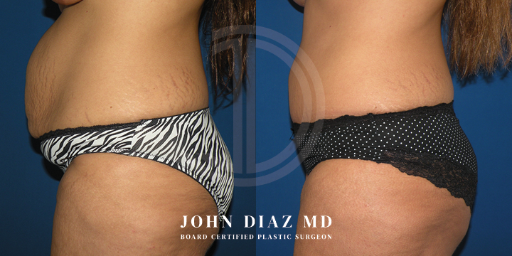 Dr John Diaz Before and After | Tummy Tuck