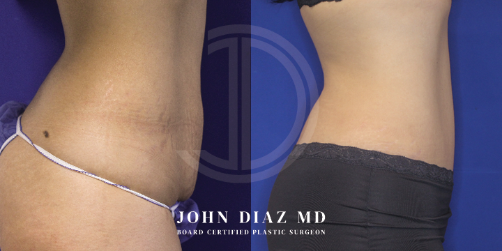 Dr John Diaz Before and After | Tummy Tuck