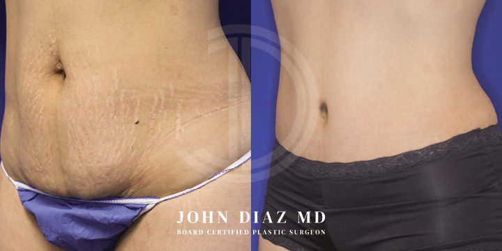 Dr John Diaz Before and After | Tummy Tuck