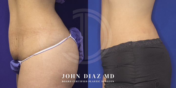 Dr John Diaz Before and After | Tummy Tuck