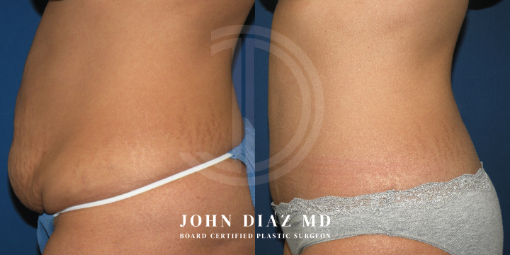 Dr John Diaz Before and After | Tummy Tuck