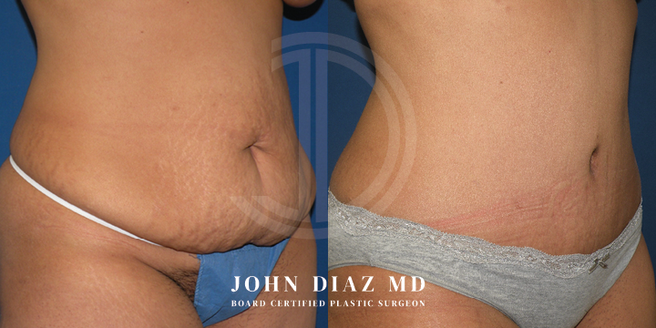 Dr John Diaz Before and After | Tummy Tuck