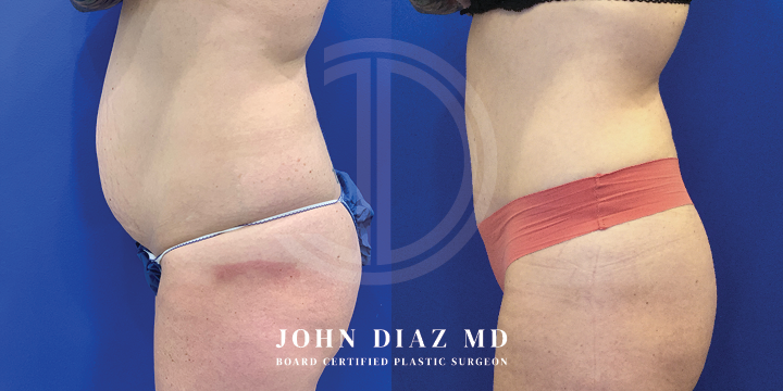 Dr John Diaz Before and After | Tummy Tuck