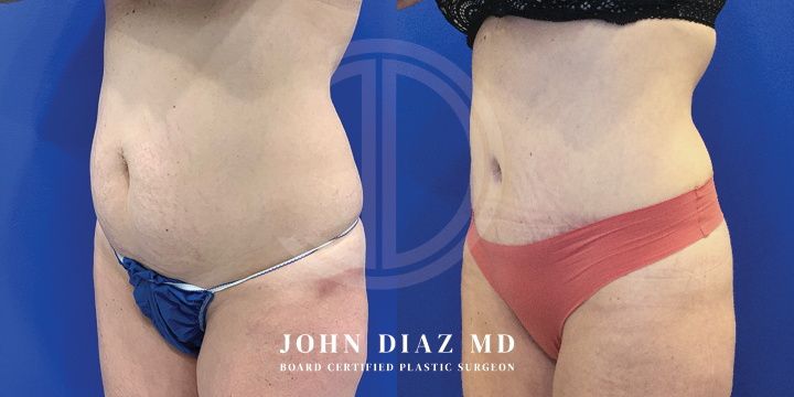 Dr John Diaz Before and After | Tummy Tuck
