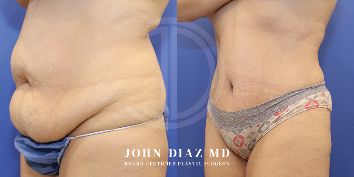 Dr John Diaz Before and After | Tummy Tuck